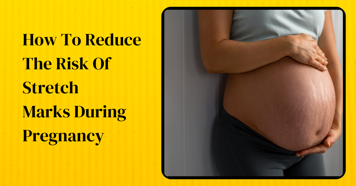 How To Reduce The Risk Of Stretch Marks During Pregnancy